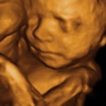 3D Ultrasound at Tiny Hearts